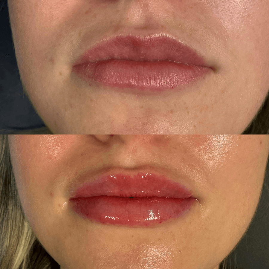 Lip Filler