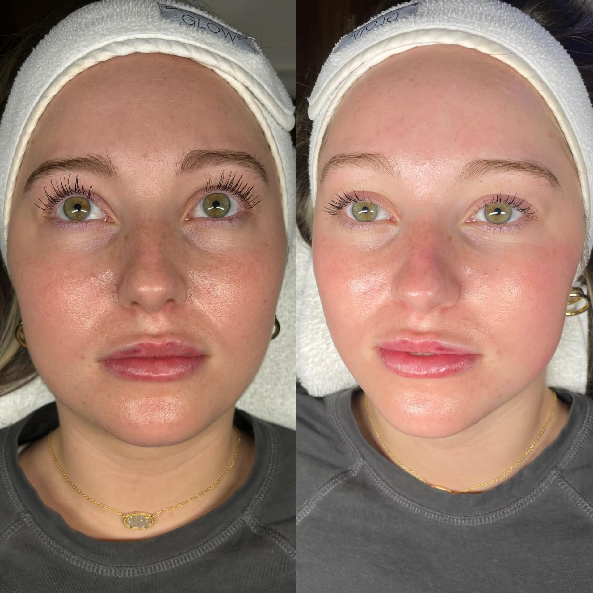 Facial Results